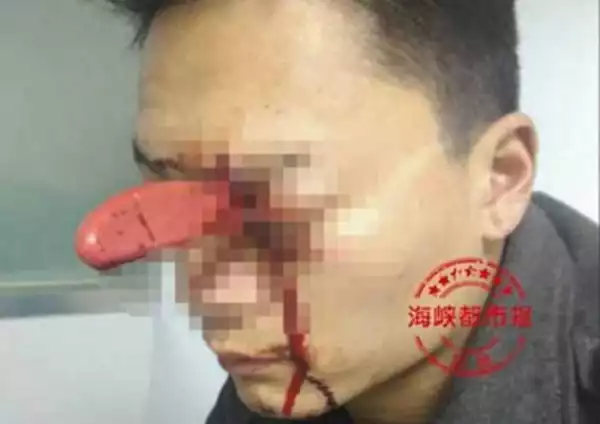 Man Calmly Waits On A Queue After Being Stabbed In The Eye By His Wife (Photos)